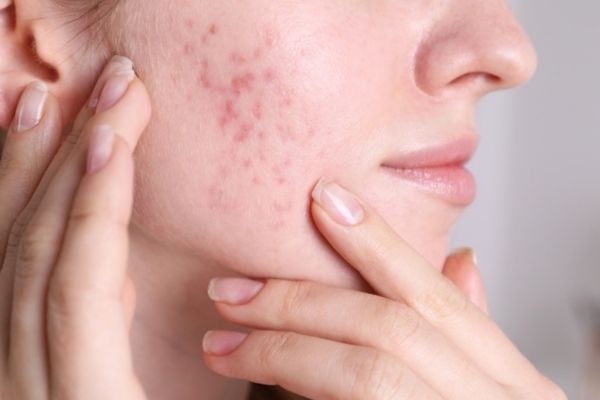Acne Scar Treatment