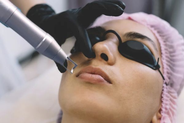 Pigment Laser